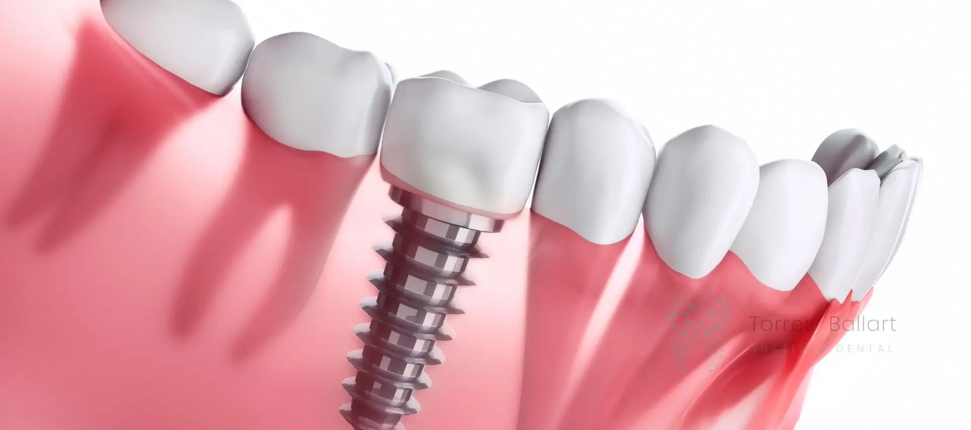 Implantes de carga inmediata en Institut Dental Torres Ballart