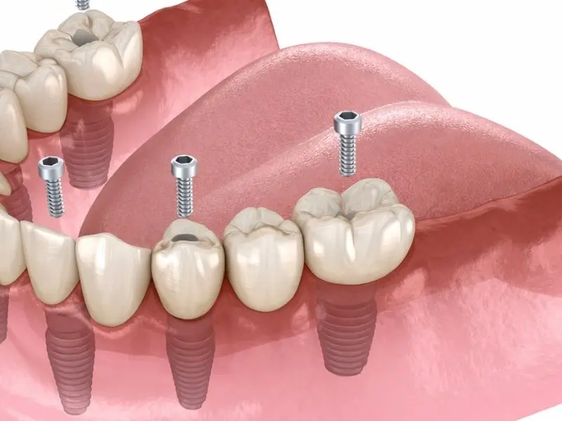Arcada completa con carga inmediata en Horta Guinardó