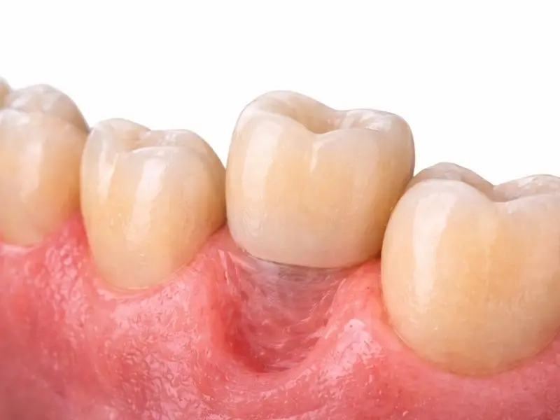 Implantes dentales cementados en Clínica Institut Dental Torres Ballart