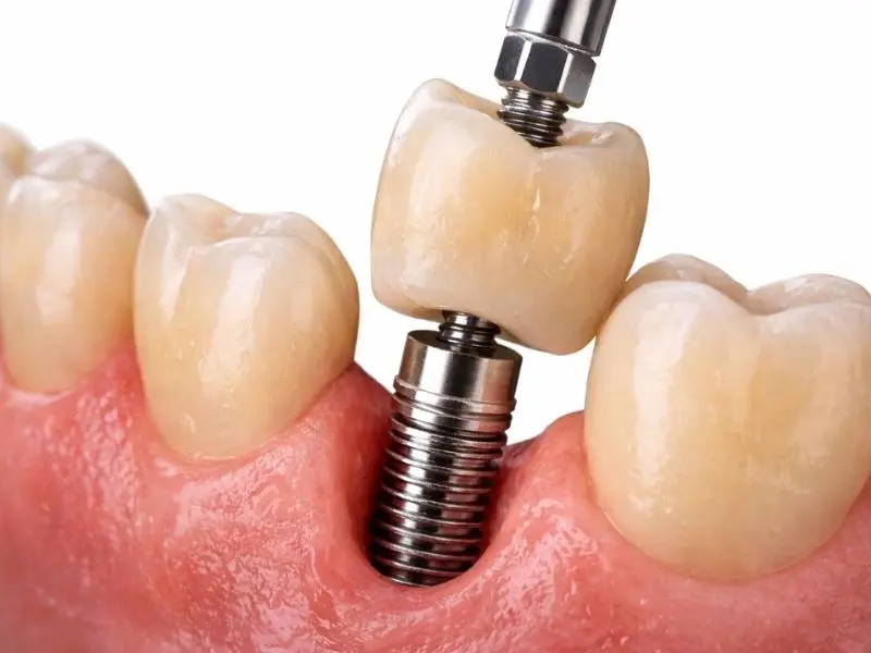 Implantes dentales unitarios en Clínica Institut Dental Torres Ballart