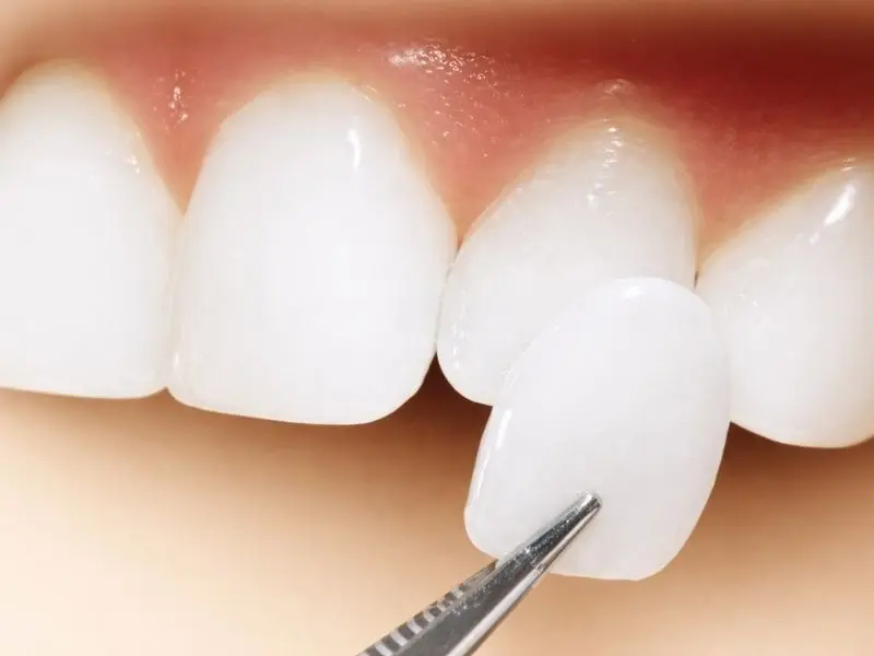 Carillas de Composite en Horta Guinardó