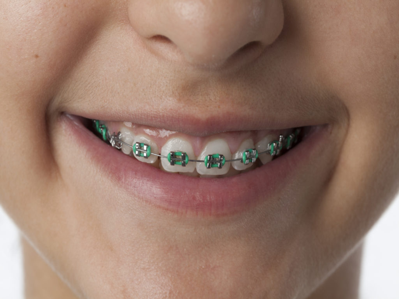 Ortodoncia con brackets infantiles