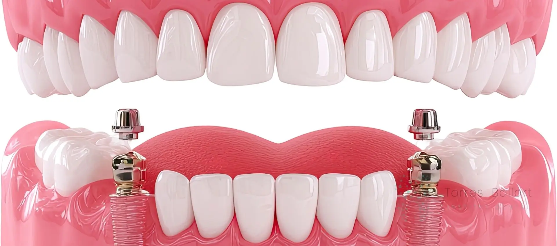 Implantes dentales en un día en Horta-Guinardó Institut Dental Torres Ballart