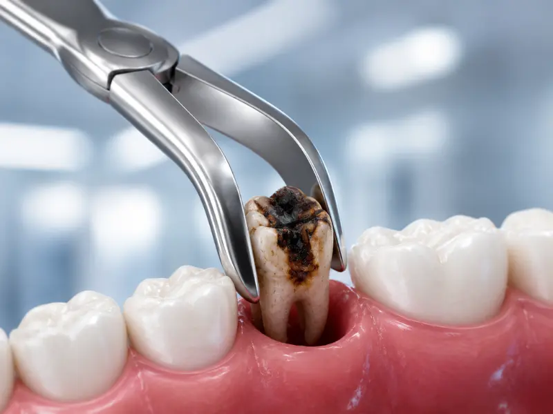 Extracción diente dañado en Horta-Guinardó Institut Dental Torres Ballart