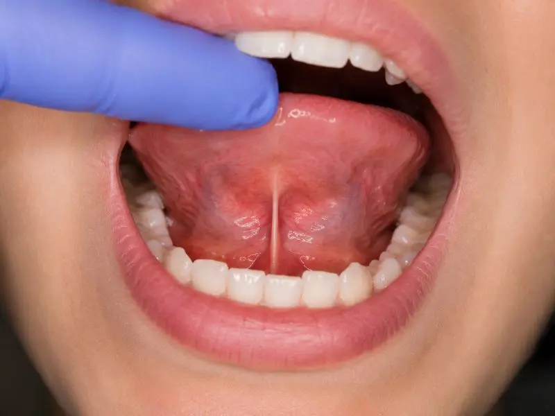 Frenectomía lingual en Horta-Guinardó Institut Dental Torres Ballart (Barcelona)