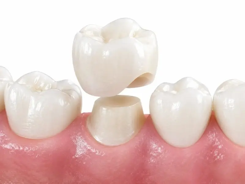 Corona sobre dientes naturales en Horta-Guinardó Institut Dental Torres Ballart
