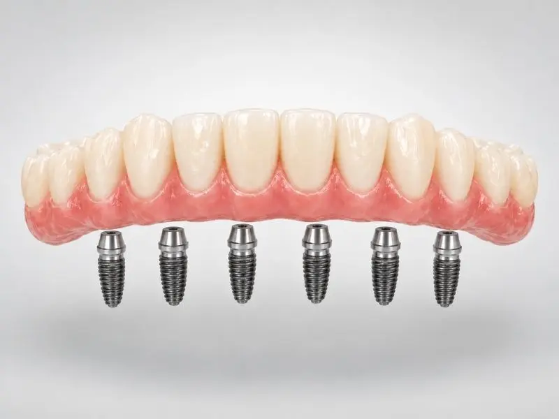 Prótesis fija de arcada completa en Institut Dental Torres Ballart, Barcelona