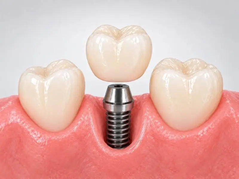 Corona fija sobre implantes en en Horta-Giunardó Barcelona Institut Dental Torres Ballart