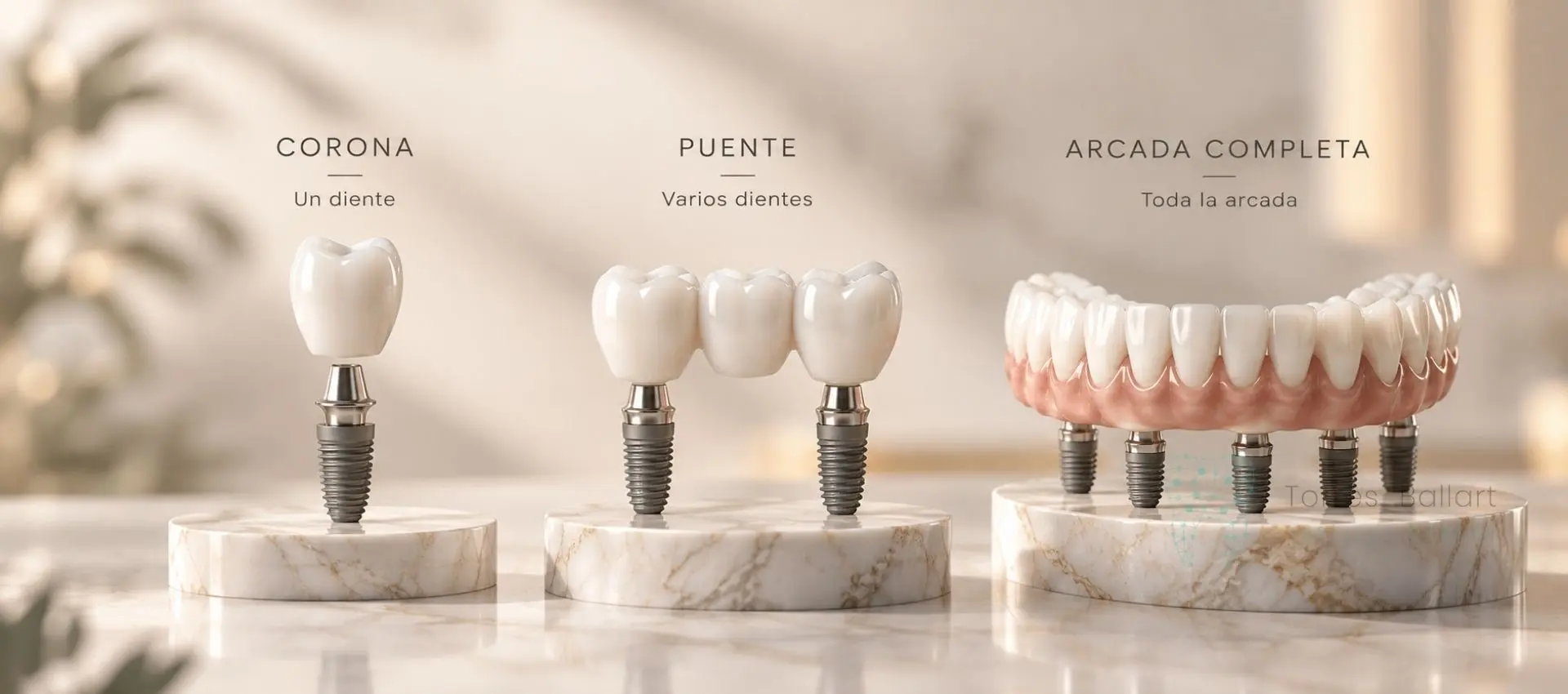 Diferencia hay entre una corona sobre implante, un puente y una arcada completa en Institut Dental Torres Ballart
