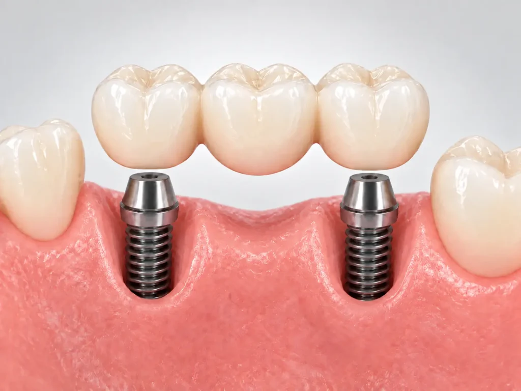 Puente fijo sobre implantes Institut Dental Torres Ballart en Horta-Guinardó (Barcelona)