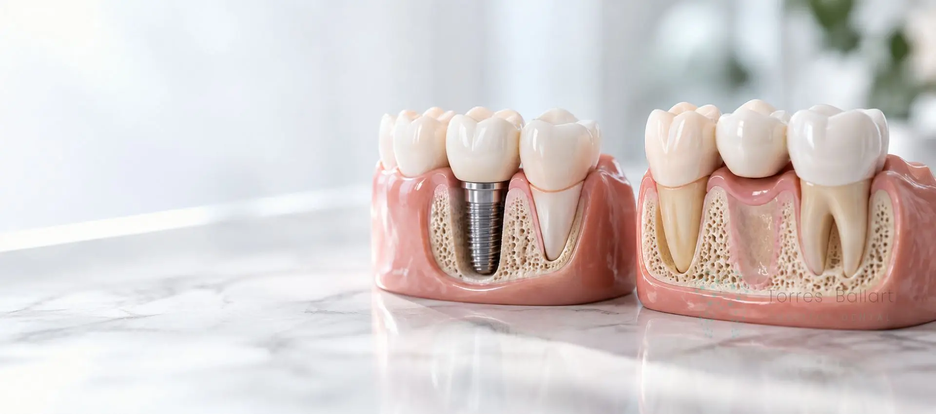 Implante unitario o puente dental en clinica Institut Dental Torres Ballart en Horta-Guinardó en Barcelona